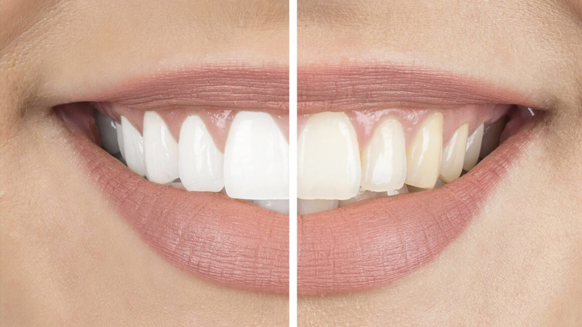 Bleaching