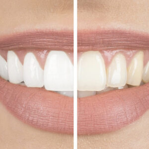Bleaching