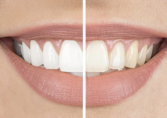 Bleaching