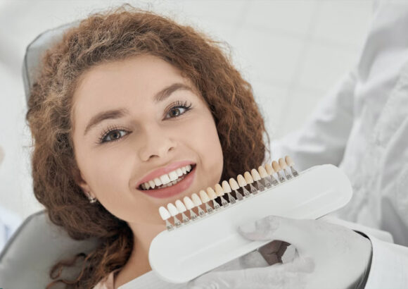 Veneers (Hollywood Smile)
